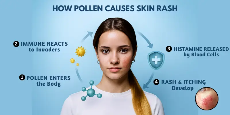 Pollen Allergy rash