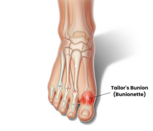 Tailor’s Bunion (Bunionette)